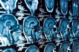 demanda por lesión cerebral