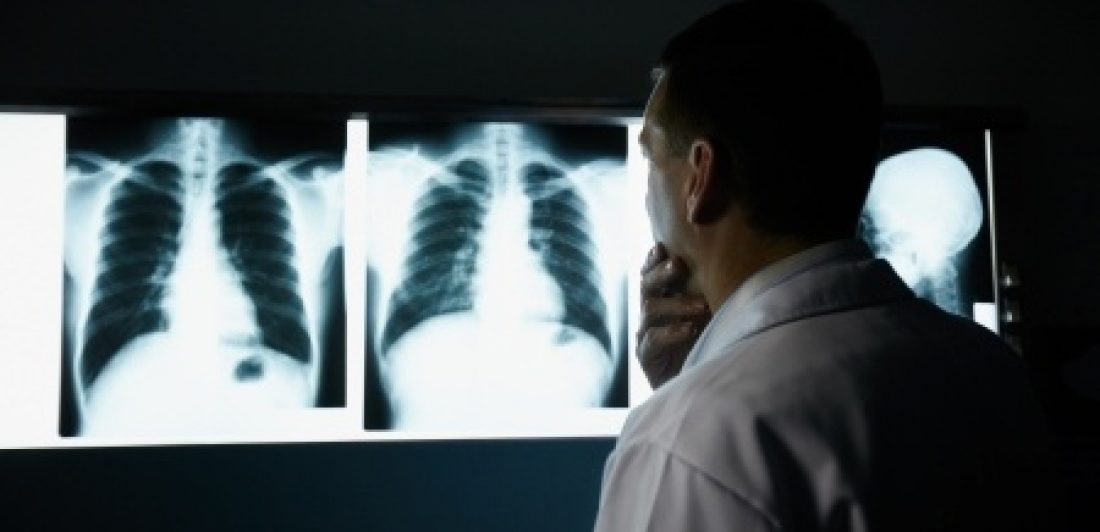 riesgo de desarrollar bronquiolitis obliterante