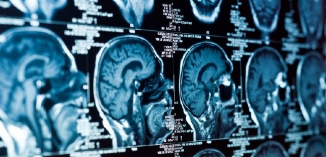 demanda por lesión cerebral